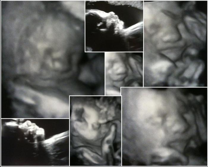 ultrason 20 haftalık fotoğraf