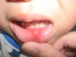 szájgyulladás gyermekek otthoni kezelésében