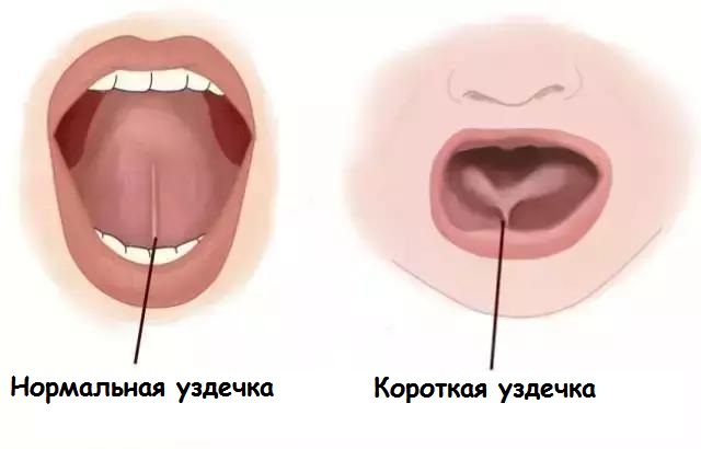 Norme du frein de la langue et pathologie