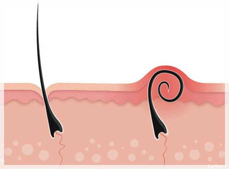 Normales und eingewachsenes Haar