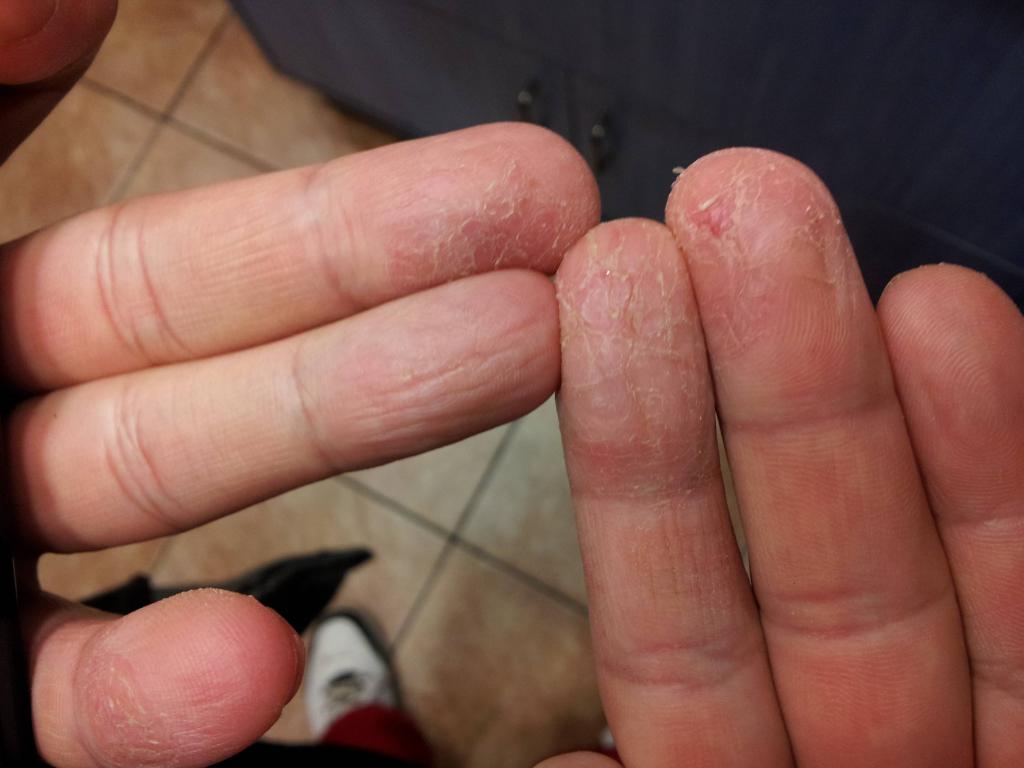 Peeling der Haut der Hände