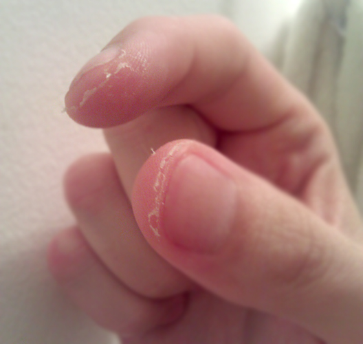 Descamación de la piel de los dedos