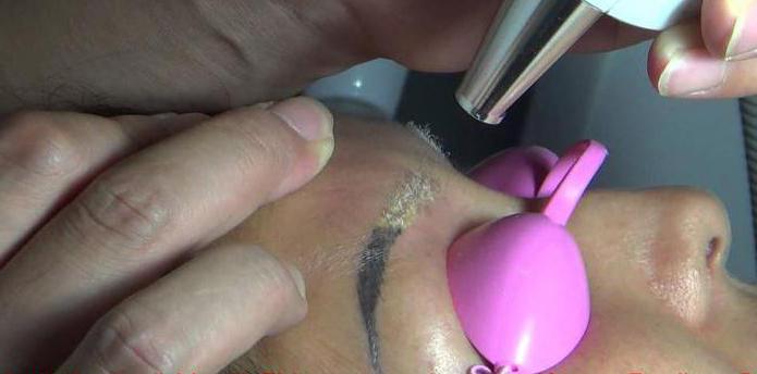 eliminación de tatuajes de cejas con láser