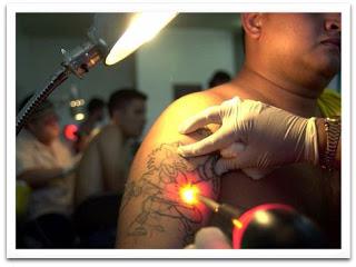 tatovering fjernelse