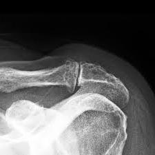 arthrose de l'articulation acromio-claviculaire