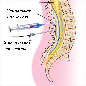 spinal anesthesia