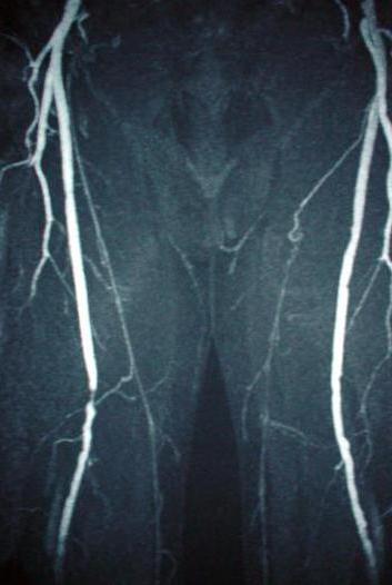 angiografie cév dolních končetin