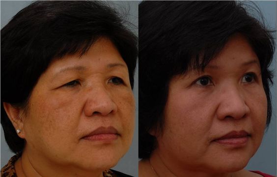 שיקום blepharoplasty של העפעף העליון