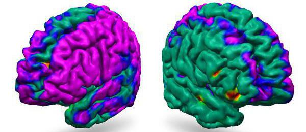 незнатне дифузне промене у биоелектричној активности мозга 