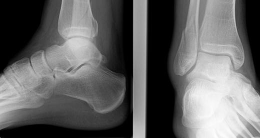 closed ankle fracture 