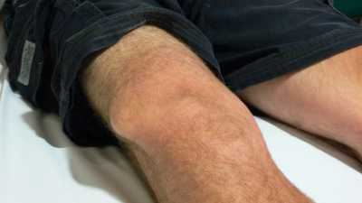 무릎 관절의 변형 관절염 원인
