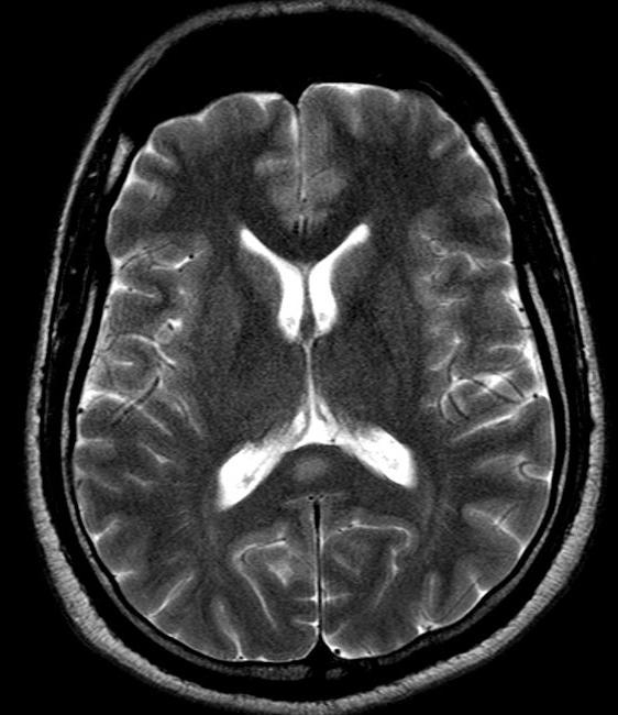 demyeliniserende prognose for hjernesygdomme 