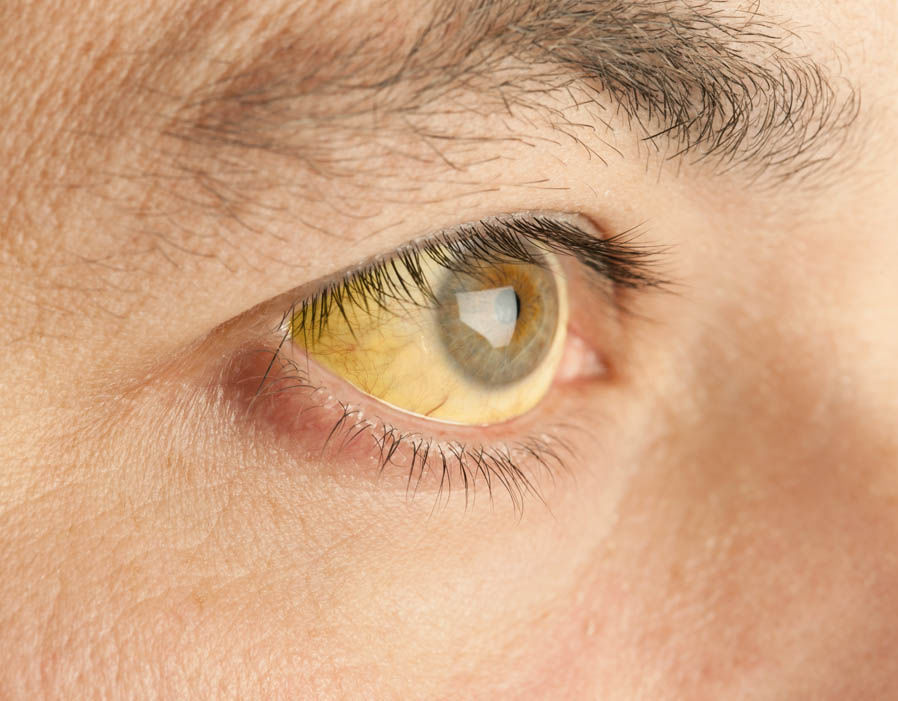 hepatosis. gul sclera af øjet