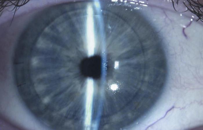 edematous degeneration of the cornea, fuchsia dystrophy