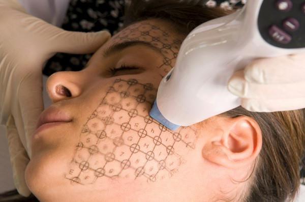 erbiumlaser in cosmetologie