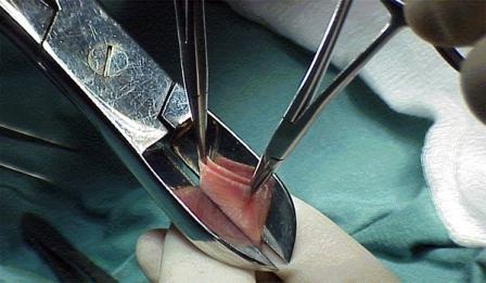 circuncisión de la fimosis