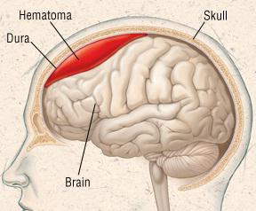 smegenų hematoma