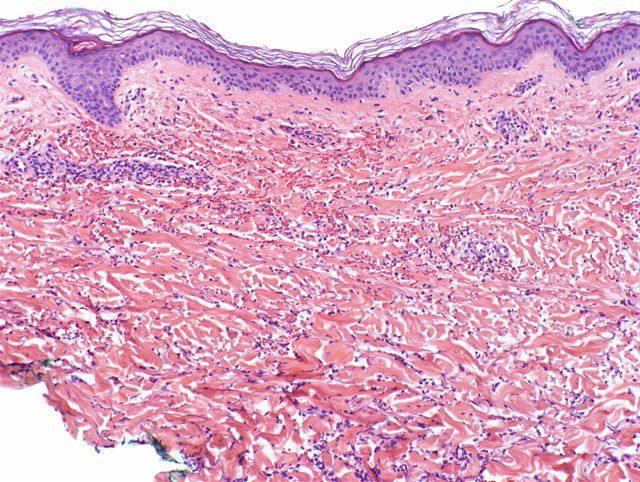 tratamiento de vasculitis hemorrágica en adultos