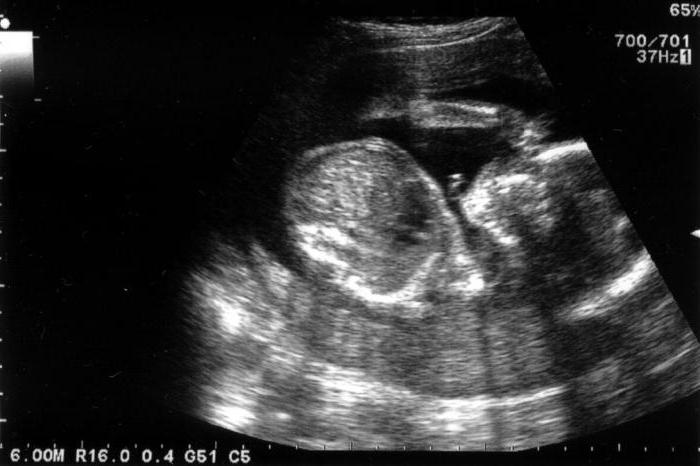 το υπερηχοϊκό έντερο στο έμβρυο προκαλεί συνέπειες