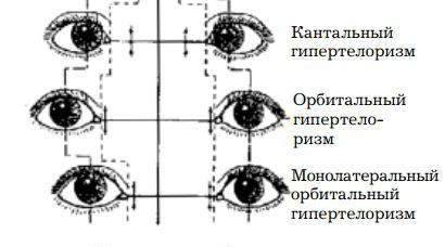 orbitálny hypertelorizmus 