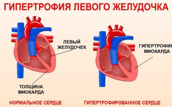 léčba hypertrofie myokardu levé komory