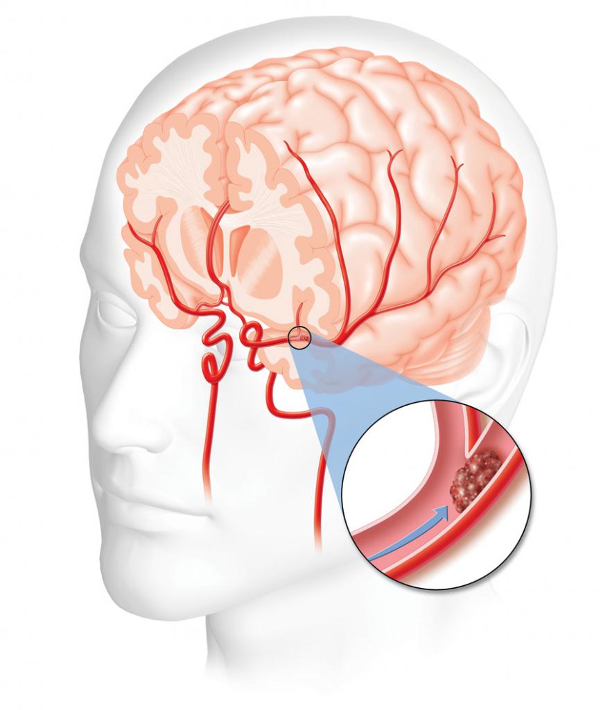 Accidente cerebrovascular isquémico