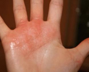 eczema disidrótico do tratamento das mãos