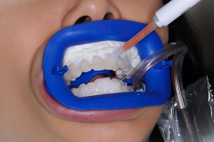новітні методи відбілювання зубів