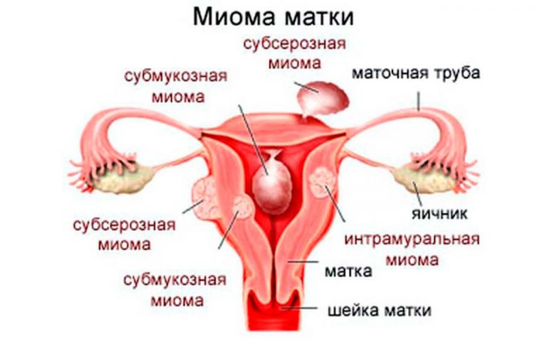 fibromas uterinos