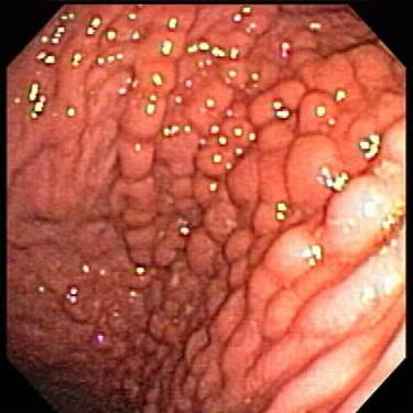 Diagnóstico dos sintomas da doença de Crohn