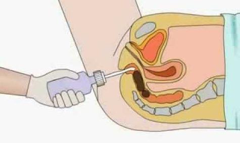 Pulizia dell'intestino con un clistere 