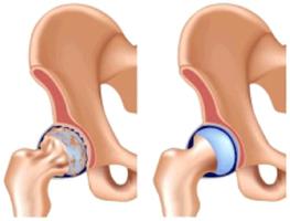 วิธีการรักษา coxarthrosis ของข้อสะโพก 