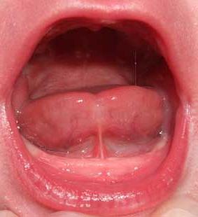 어린이의 혀의 짧은 frenum