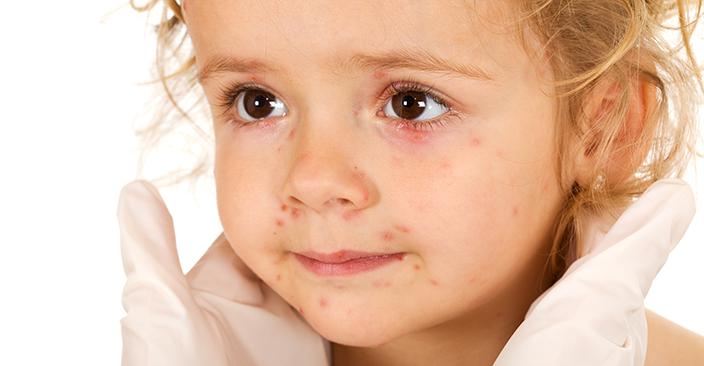 Síntomas de sarampión por sarampión en niños.