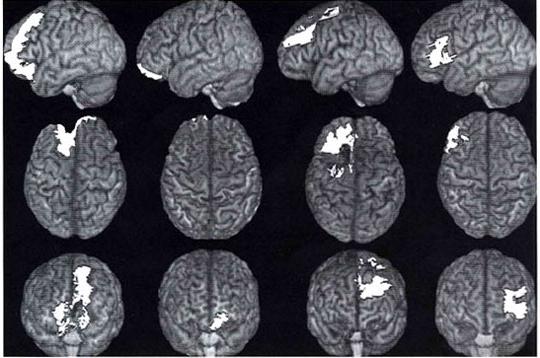 intracerebral hemorrhage