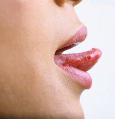 behandling av stomatitt i tungen
