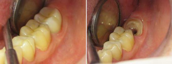 denti per ceramica metallica