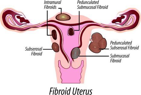 dzemdes fibroīdu izmēri operācijai