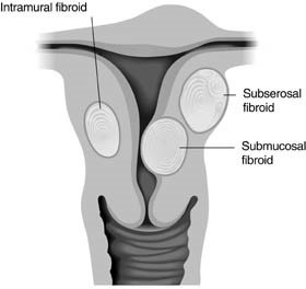 dzemdes fibroīdu izmērs nedēļās