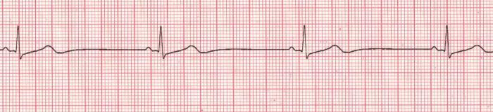 40 साल के पुरुषों में पल्स रेट