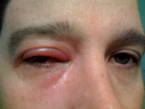 zwelling van de bovenste oogleden veroorzaakt