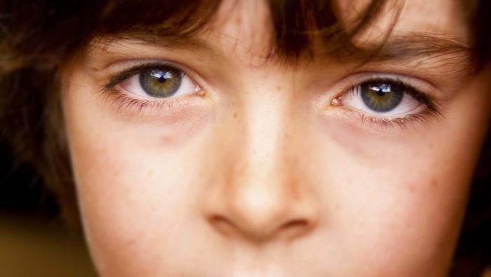 алергија свраб у очима