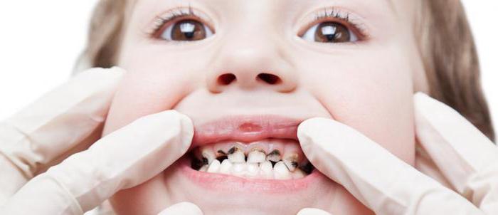 tooth decay in children 