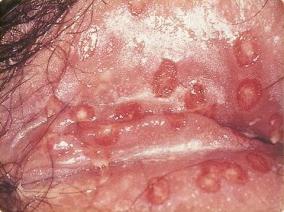 Genitalijų infekcijos, niežėjimas