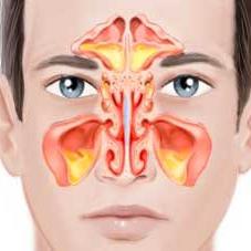 Znakovi sinusitisa i liječenje