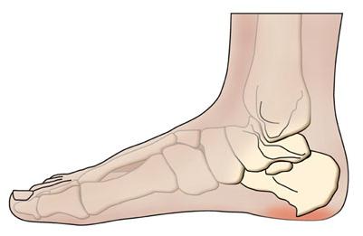 trattamento farmacologico per sperone calcaneare