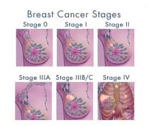 vše o rakovině prsu a její léčbě 