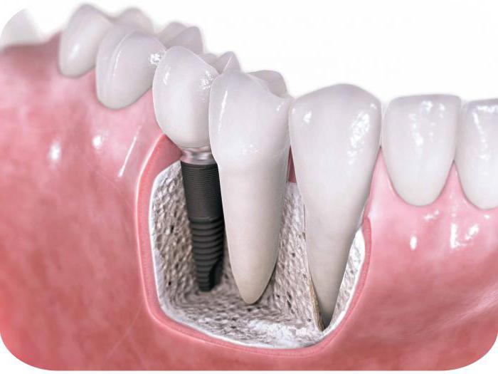  closed sinus lift 