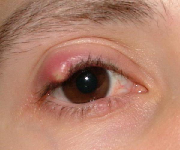 Augenkrankheit Gerste 