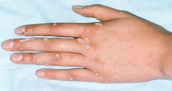 Heilmittel für Papillomaschlitten Haut Bewertungen 